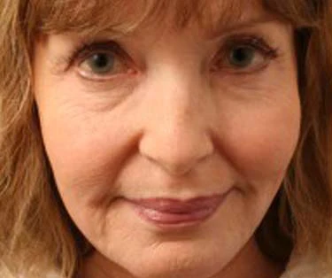 Photograph of patient after receiving Blepharoplasty surgery - Eyelid Surgery for droopy eyes.