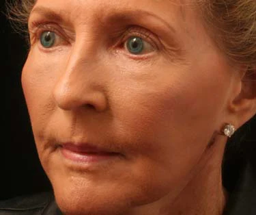 Photograph of patient after receiving Blepharoplasty surgery - Eyelid Surgery for droopy eyes.