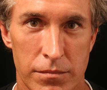 Photograph of patient after receiving Blepharoplasty surgery - Eyelid Surgery for droopy eyes.