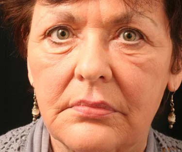 Photograph of patient after receiving Blepharoplasty surgery - Eyelid Surgery for droopy eyes.