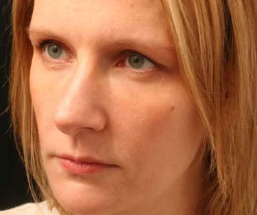 Photograph of patient after receiving Blepharoplasty surgery - Eyelid Surgery for droopy eyes.