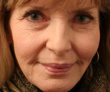 Photograph of patient before receiving Blepharoplasty surgery - Eyelid Surgery for droopy eyes.