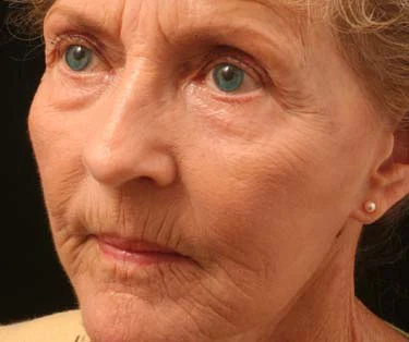 Photograph of patient before receiving Blepharoplasty surgery - Eyelid Surgery for droopy eyes.
