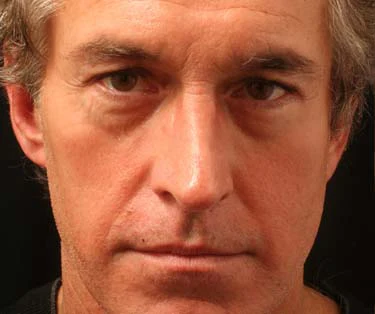 Photograph of patient before receiving Blepharoplasty surgery - Eyelid Surgery for droopy eyes.