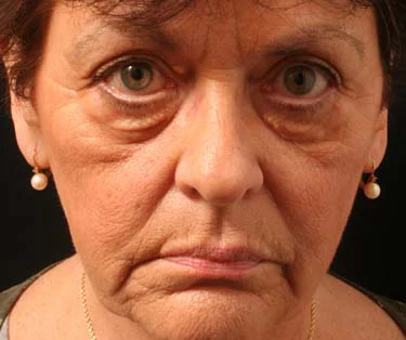 Photograph of patient before receiving Blepharoplasty surgery - Eyelid Surgery for droopy eyes.