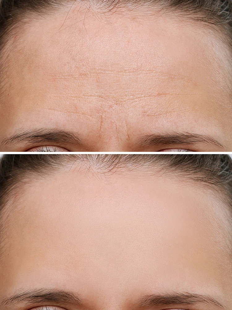Before and after results of Botox treatments in Memphis showing smooth skin