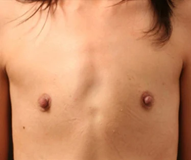 Photograph of patient before receiving Breast Augmentation surgery