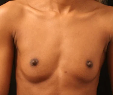 Photograph of patient before receiving Breast Augmentation surgery