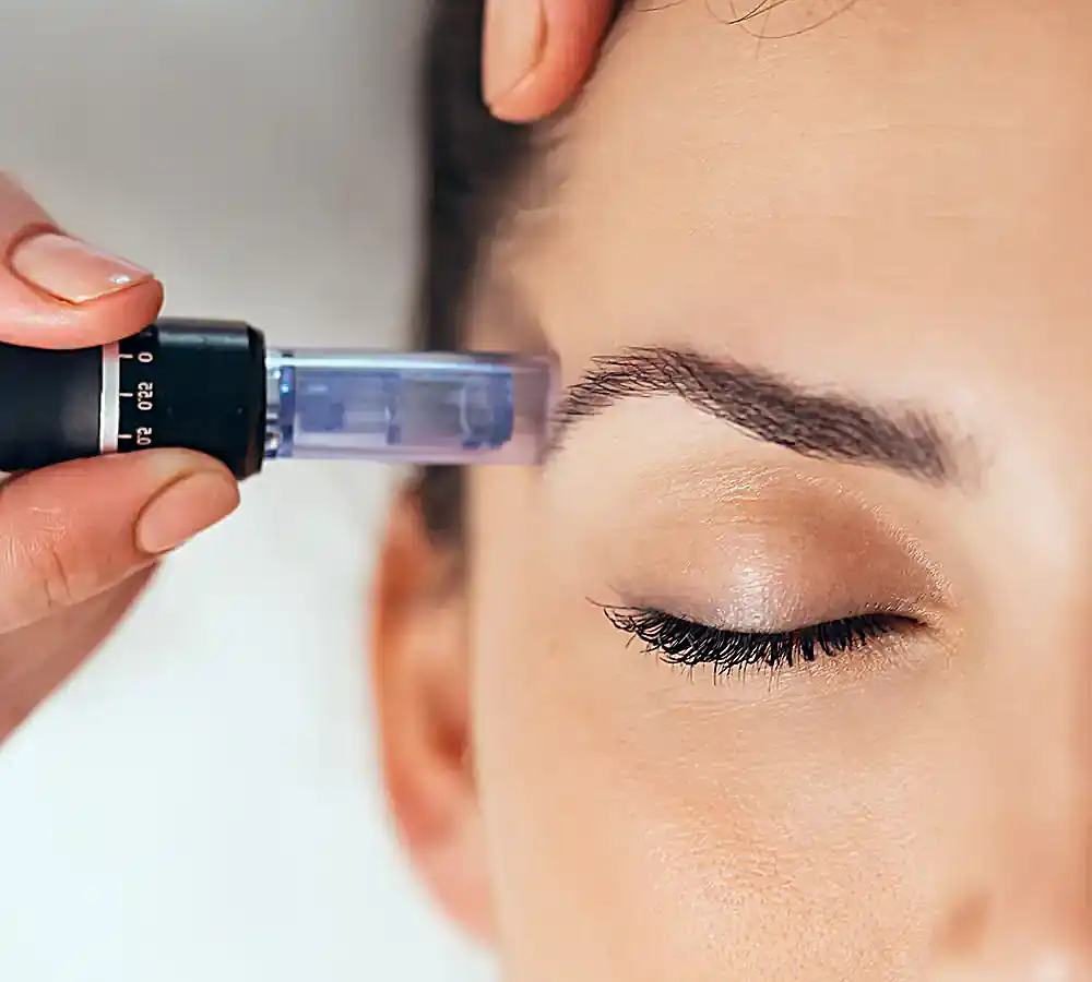 Collagen Induction Therapy treatment process