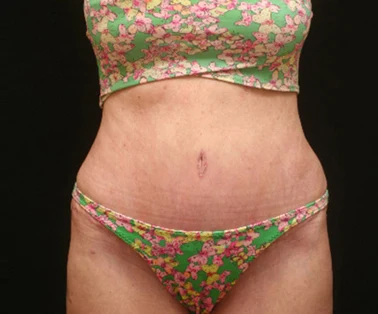 Photo of patient after having a CombiTuck surgery - a combination of liposuction and a tummy tuck.
