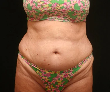 Photo of patient before CombiTuck surgery - a combination of liposuction and a tummy tuck.