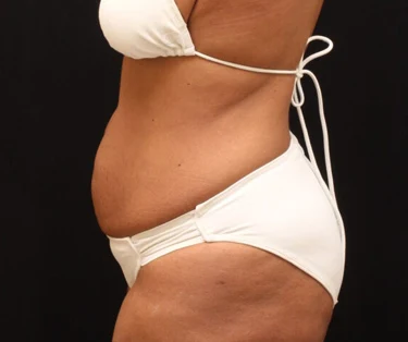 Photo of patient before CombiTuck surgery - a combination of liposuction and a tummy tuck.