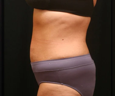 Photo of patient after having a CombiTuck surgery - a combination of liposuction and a tummy tuck.