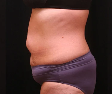 Photo of patient before CombiTuck surgery - a combination of liposuction and a tummy tuck.