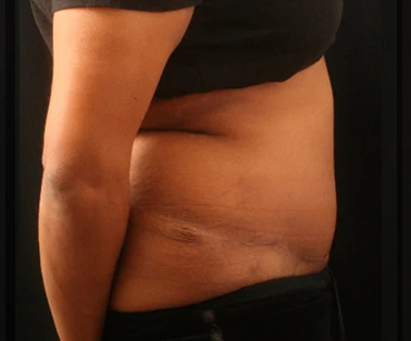Photo of patient after having a CombiTuck surgery - a combination of liposuction and a tummy tuck.