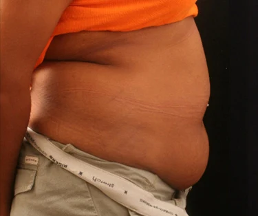 Photo of patient before CombiTuck surgery - a combination of liposuction and a tummy tuck.