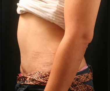 Photo of patient after having a CombiTuck surgery - a combination of liposuction and a tummy tuck.