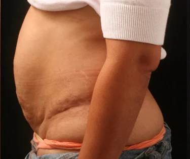 Photo of patient before CombiTuck surgery - a combination of liposuction and a tummy tuck.