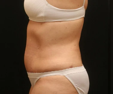 Photo of patient after having a CombiTuck surgery - a combination of liposuction and a tummy tuck.