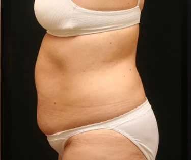 Photo of patient before CombiTuck surgery - a combination of liposuction and a tummy tuck.