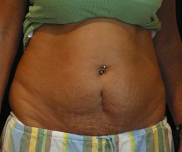 Photo of patient before CombiTuck surgery - a combination of liposuction and a tummy tuck.