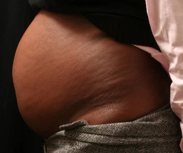 Photo of patient before CombiTuck surgery - a combination of liposuction and a tummy tuck.