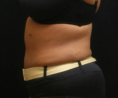 Photo of patient after having a CombiTuck surgery - a combination of liposuction and a tummy tuck.