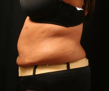 Photo of patient before CombiTuck surgery - a combination of liposuction and a tummy tuck.