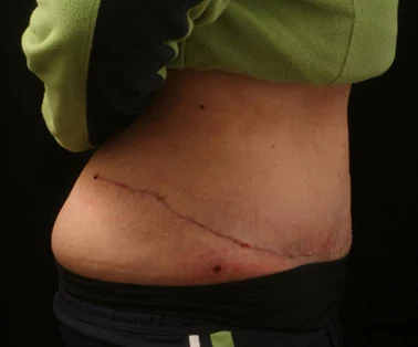 Photo of patient after having a CombiTuck surgery - a combination of liposuction and a tummy tuck.