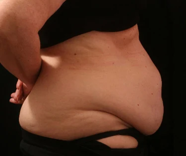 Photo of patient before CombiTuck surgery - a combination of liposuction and a tummy tuck.