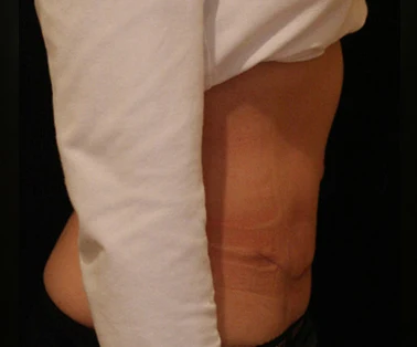 Photo of patient after having a CombiTuck surgery - a combination of liposuction and a tummy tuck.
