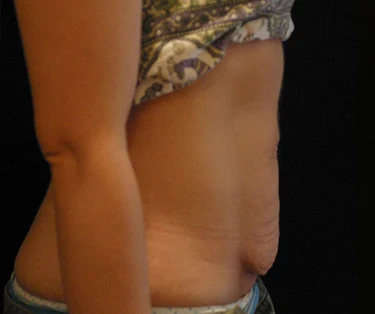 Photo of patient before CombiTuck surgery - a combination of liposuction and a tummy tuck.