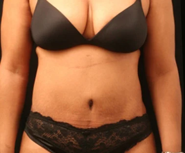 Photo of patient after having a CombiTuck surgery - a combination of liposuction and a tummy tuck.