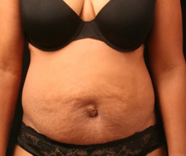 Photo of patient before CombiTuck surgery - a combination of liposuction and a tummy tuck.