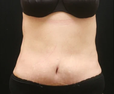 Photo of patient after having a CombiTuck surgery - a combination of liposuction and a tummy tuck.