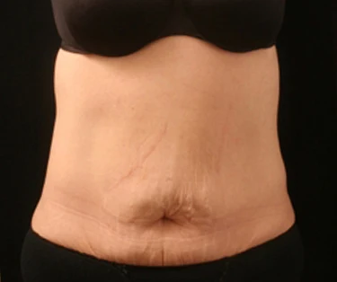 Photo of patient before CombiTuck surgery - a combination of liposuction and a tummy tuck.