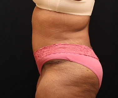 Photo of patient after having a CombiTuck surgery - a combination of liposuction and a tummy tuck.
