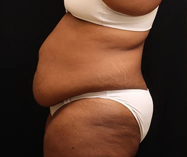 Photo of patient before CombiTuck surgery - a combination of liposuction and a tummy tuck.