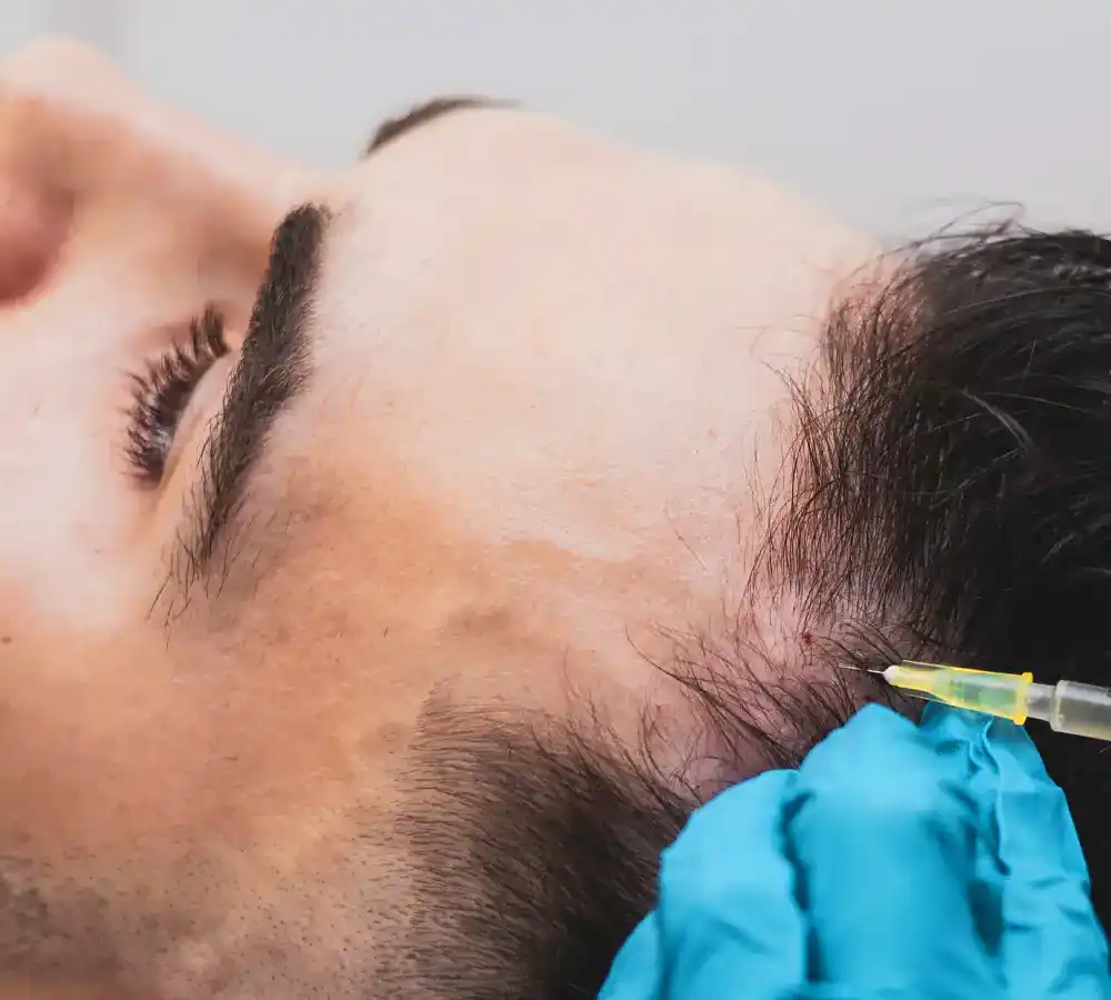 PRP hair restoration treatment results