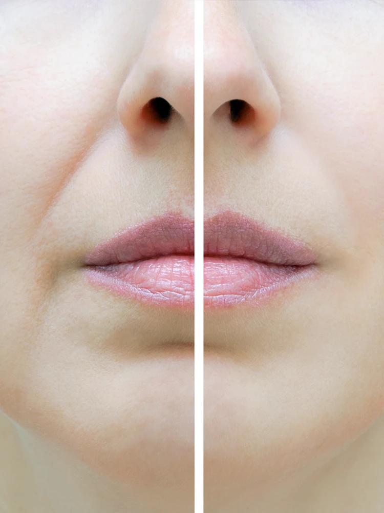 Before and after results showing Juvederm dermal filler treatment benefits