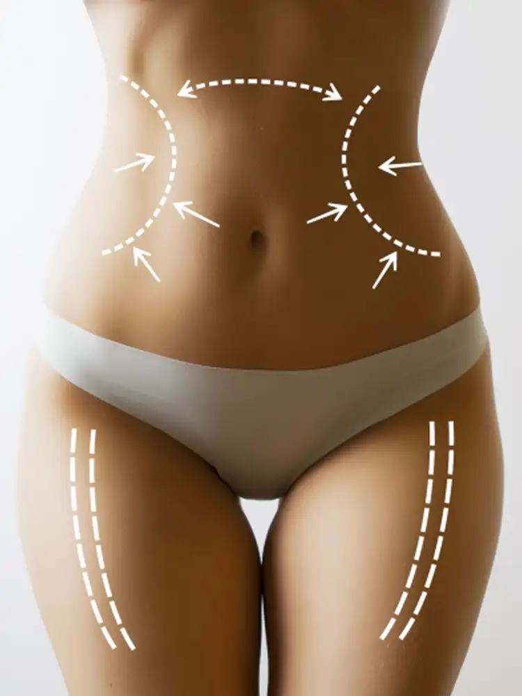 Body contouring results showing sculpted physique transformation