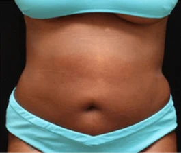 After Liposuction: Front view of abdomen area showing improved contour and reduced fat