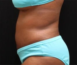 After Liposuction: Side view of abdomen area showing improved contour and reduced fat