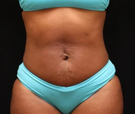 After Liposuction: Oblique view of abdomen area showing improved contour and reduced fat