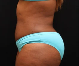 After Liposuction: Back view showing improved contour and reduced fat