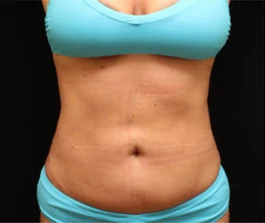 After Liposuction: Profile view showing sculpted results and improved body contour