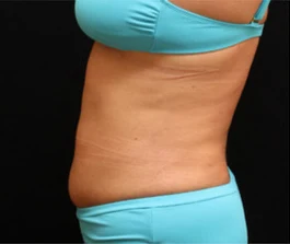 After Liposuction: Three-quarter view showing enhanced body contours