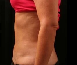 After Liposuction: Front view showing refined body shape