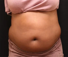 Before Liposuction: Front view of abdomen area showing excess fat deposits