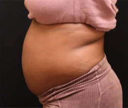 Before Liposuction: Side view of abdomen area showing excess fat deposits